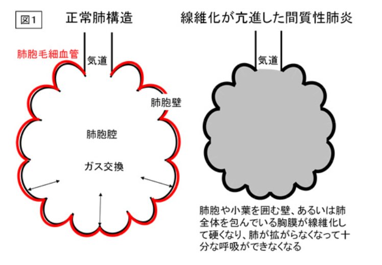 肺胞の線維化